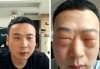 带 “慧琳” 的名字:在线测算八字www.jixiangqiming.vip：-8颗蝉蛹下肚，男子眼睛肿成“奥特曼”！有人吃了喘不过气快要窒息